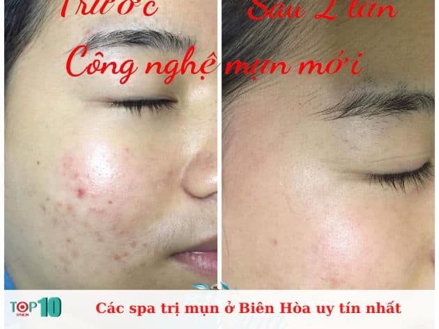 Các spa trị mụn ở Biên Hòa uy tín nhất