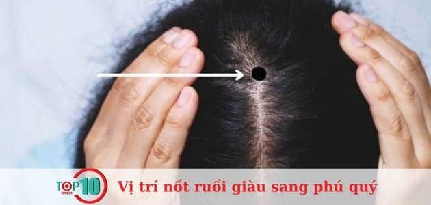 Nốt ruồi xuất hiện trên đỉnh đầu