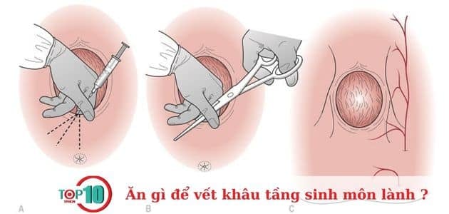 Rạch tầng sinh môn giúp quá trình sinh nở thuận lợi hơn