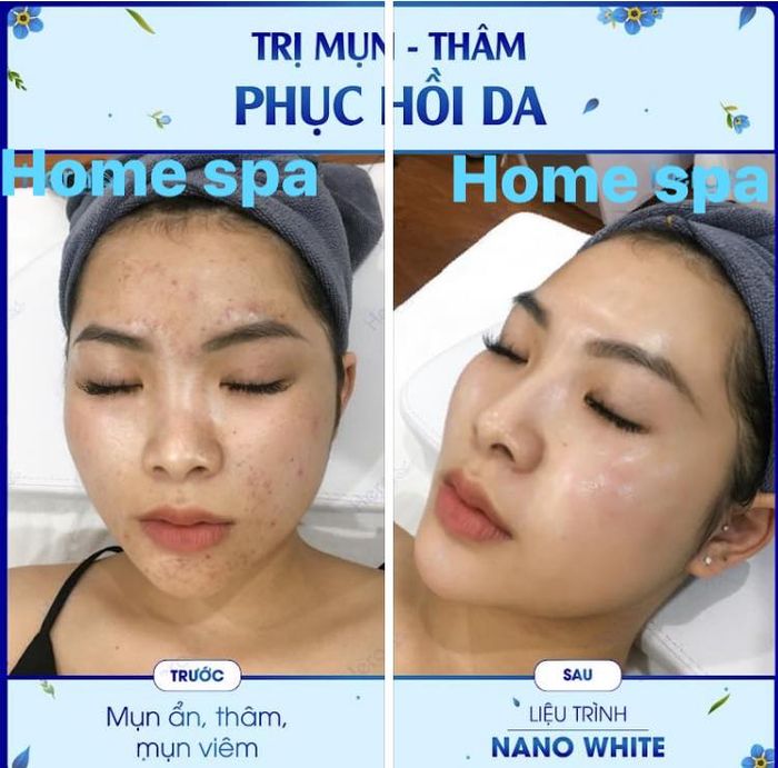 Spa trị mụn Quận 4 - Home Spa