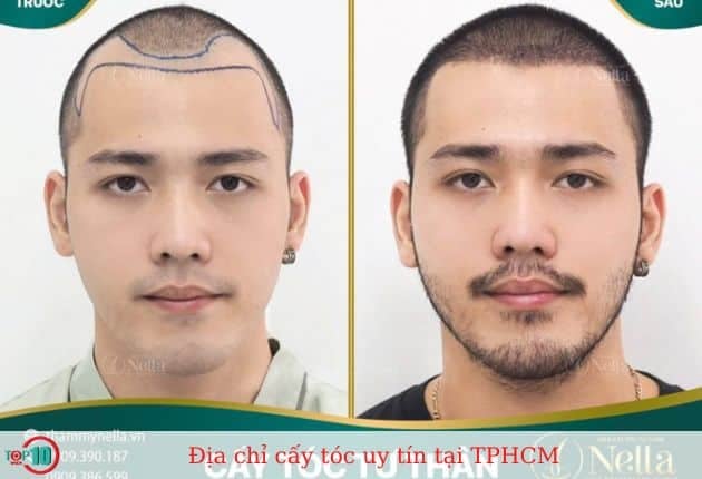 Viện Cấy Tóc Tự Thân Nella