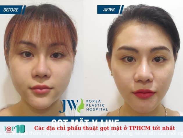 Gọt cằm ở đâu uy tín?