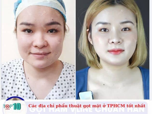 Các địa chỉ phẫu thuật gọt mặt uy tín nhất tại TPHCM