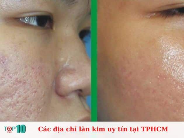 Những địa chỉ lăn kim đáng tin cậy tại TPHCM