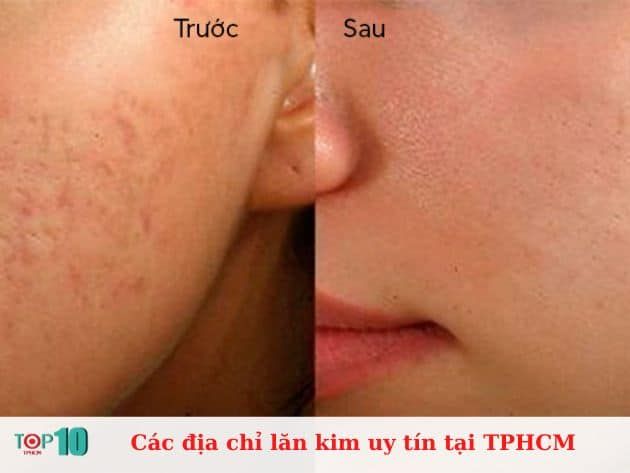 Các địa chỉ lăn kim đáng tin cậy tại TPHCM