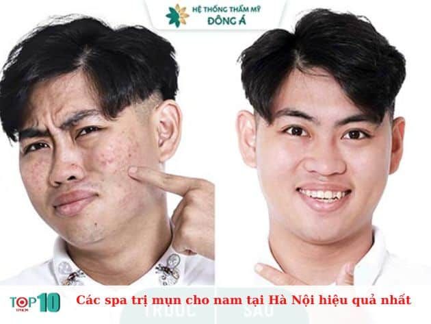 Các spa điều trị mụn cho nam tại Hà Nội hiệu quả nhất