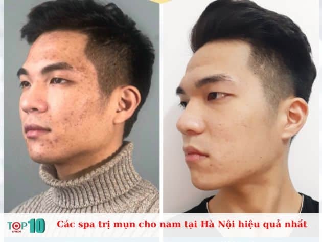 Những spa trị mụn hiệu quả nhất cho nam giới tại Hà Nội