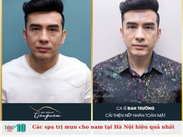 Những spa trị mụn hiệu quả nhất cho nam giới tại Hà Nội