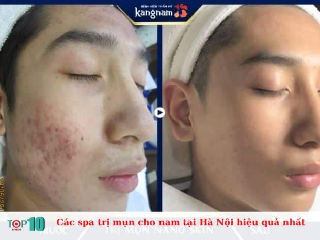 Những spa trị mụn hiệu quả nhất cho nam giới tại Hà Nội