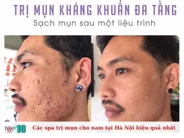 Những spa trị mụn hiệu quả nhất cho nam giới tại Hà Nội