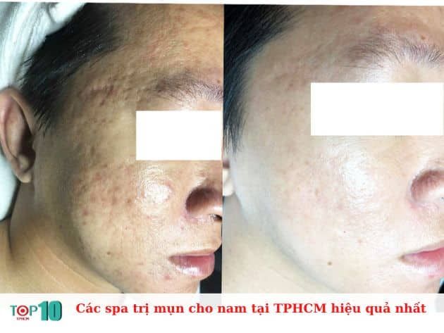 Những spa trị mụn cho nam tại TPHCM hiệu quả nhất