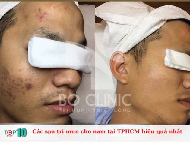 Những spa trị mụn hiệu quả nhất cho nam tại TPHCM