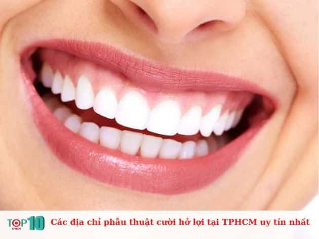 Danh sách các địa chỉ uy tín phẫu thuật cười hở lợi tại TPHCM