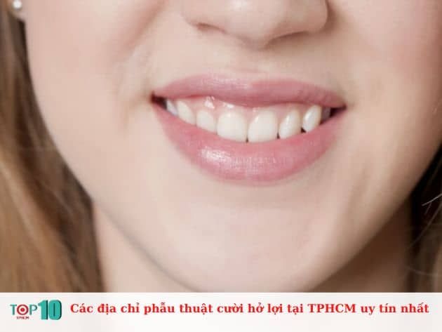 Những địa chỉ uy tín nhất để phẫu thuật cười hở lợi tại TPHCM