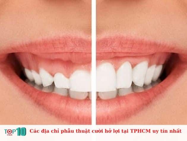 Những địa chỉ phẫu thuật cười hở lợi uy tín nhất tại TPHCM