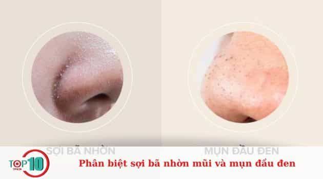 Cách phân biệt sợi bã nhờn và mụn đầu đen trên mũi