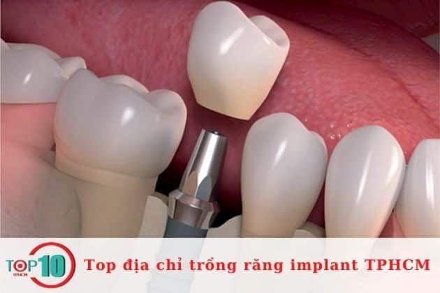 Địa chỉ cấy ghép răng implant uy tín tại TPHCM | Nguồn: Nha khoa Peace Dentistry