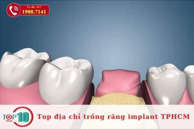 Trồng răng implant chất lượng uy tín tại TPHCM| Nguồn: Nha Khoa Đông Nam