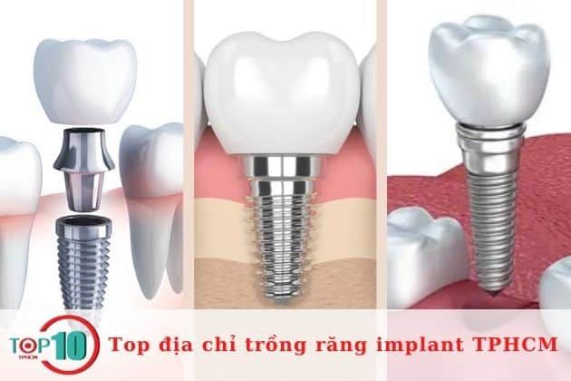 Danh sách các địa chỉ cấy ghép răng implant đáng tin cậy nhất tại TPHCM