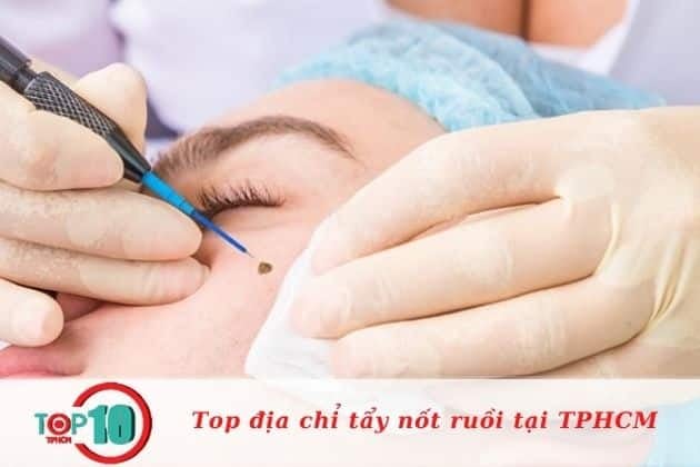 Địa chỉ tẩy nốt ruồi chất lượng tại TPHCM | Nguồn: Bệnh viện Da liễu TP.HCM