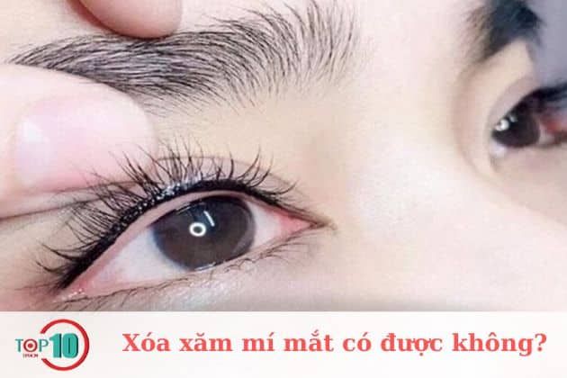 Xóa xăm mí mắt ở đâu là tốt nhất?