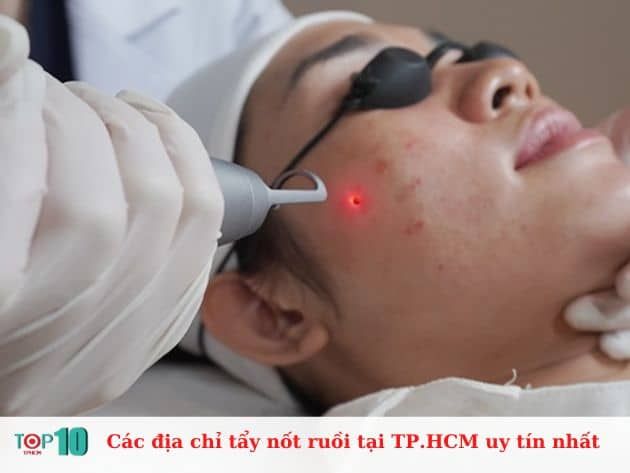 Các địa chỉ tẩy nốt ruồi uy tín tại TP.HCM