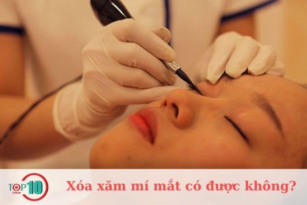 Có nên thực hiện xóa xăm mí mắt không?