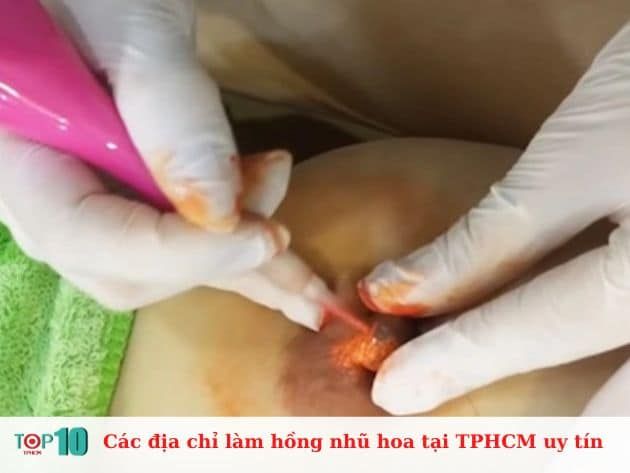 Danh sách các địa chỉ làm hồng nhũ hoa uy tín tại TP.HCM