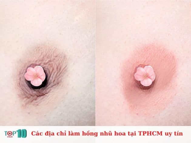 Các địa chỉ làm hồng nhũ hoa uy tín tại TP.HCM