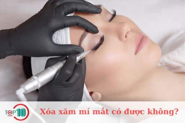 Liệu việc xóa xăm mí mắt có thực hiện được không?