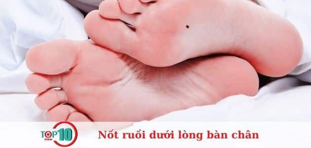 Nốt ruồi dưới lòng bàn chân