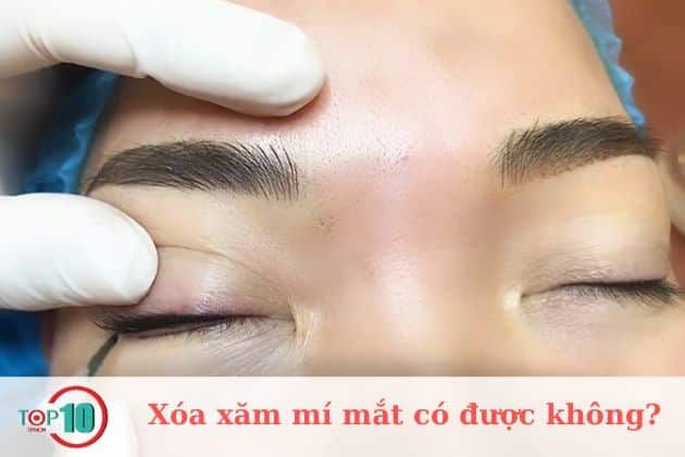 Xóa xăm mí mắt có nguy hiểm không?