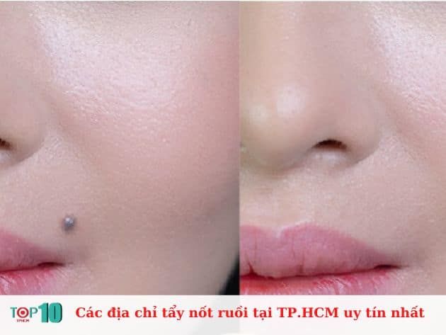 Những địa chỉ tẩy nốt ruồi uy tín tại TP.HCM