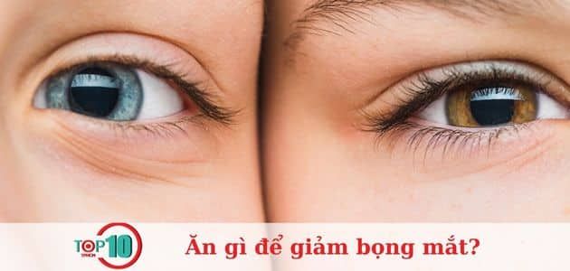 Những dấu hiệu của bọng mắt