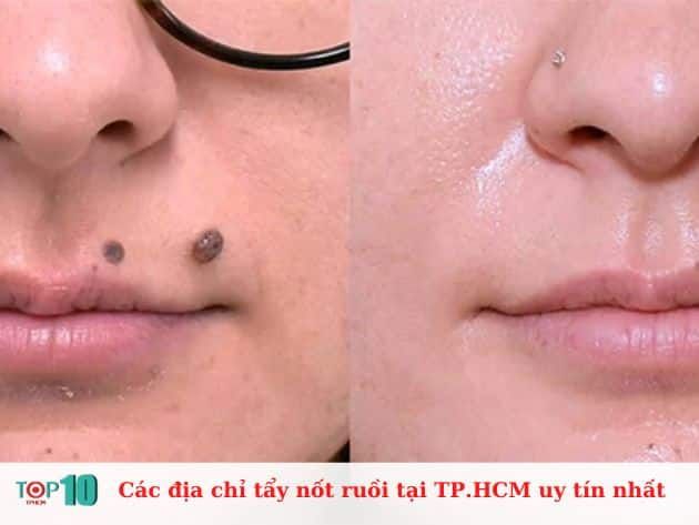 Các cơ sở tẩy nốt ruồi uy tín tại TP.HCM