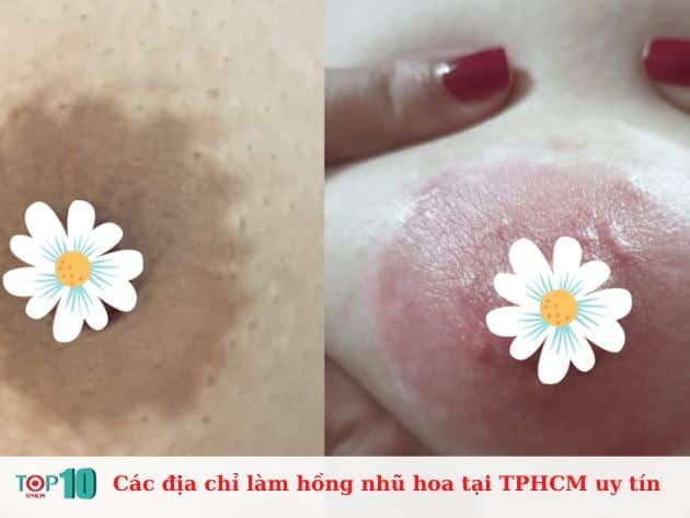 Các địa chỉ làm hồng nhũ hoa uy tín tại TPHCM