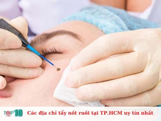 Những địa chỉ hàng đầu để tẩy nốt ruồi tại TP.HCM