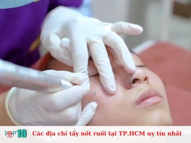 Các địa chỉ tẩy nốt ruồi uy tín nhất tại TP.HCM