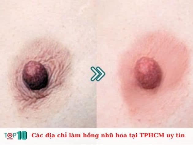 Những địa chỉ làm hồng nhũ hoa uy tín tại TP.HCM