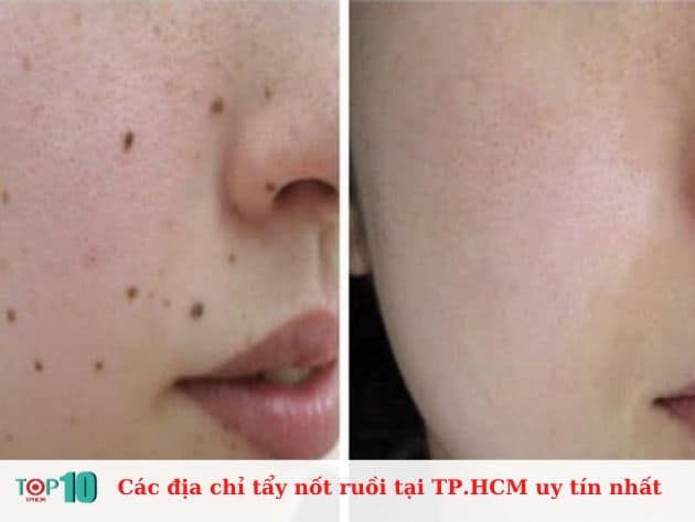 Danh sách các địa chỉ tẩy nốt ruồi uy tín tại TP.HCM