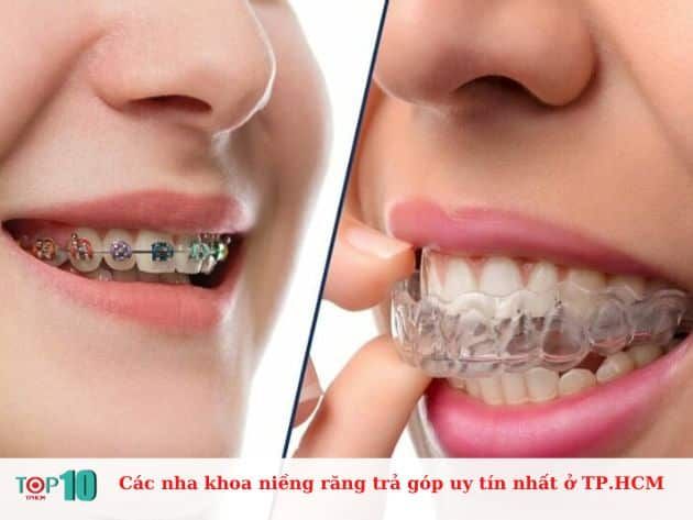 Những nha khoa niềng răng có dịch vụ trả góp uy tín nhất tại TP.HCM