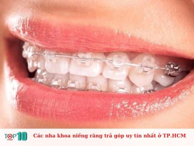 Danh sách các nha khoa uy tín tại TP.HCM cung cấp dịch vụ niềng răng trả góp