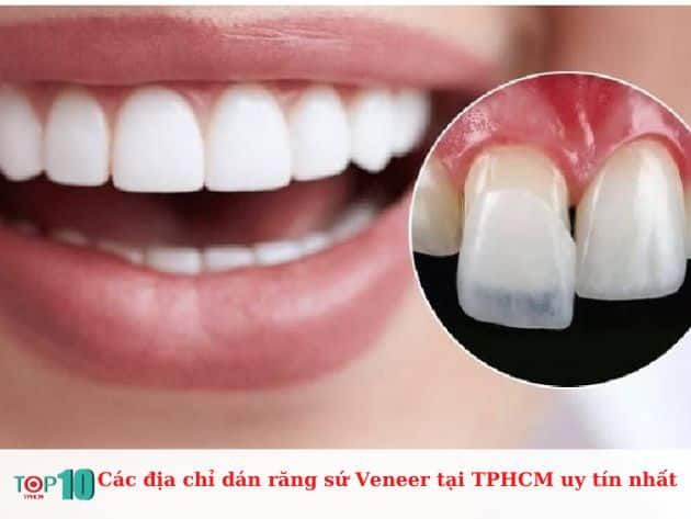 Các địa chỉ dán răng sứ Veneer uy tín tại TP.HCM