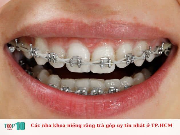 Danh sách các nha khoa niềng răng trả góp uy tín tại TP.HCM