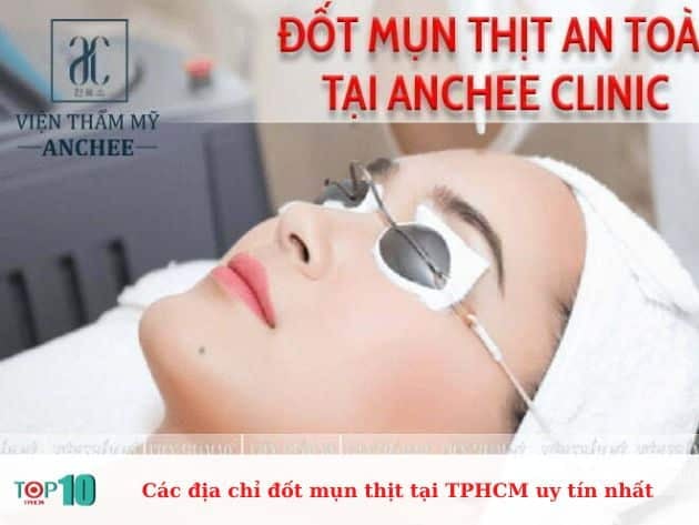 Danh sách các địa chỉ đốt mụn thịt uy tín tại TPHCM