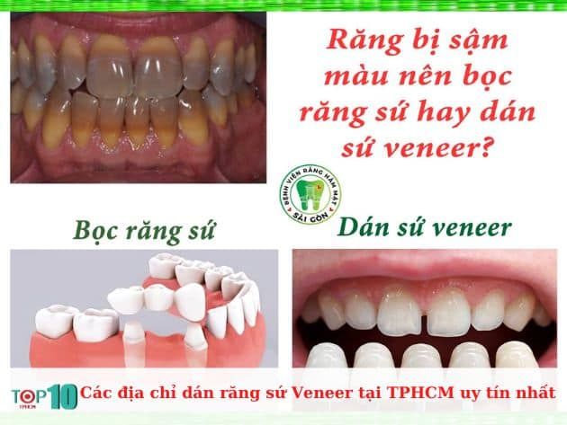 Các cơ sở uy tín dán răng sứ veneer tại TP.HCM