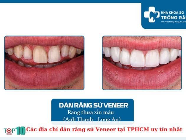 Những địa chỉ dán răng sứ Veneer uy tín nhất tại TP.HCM