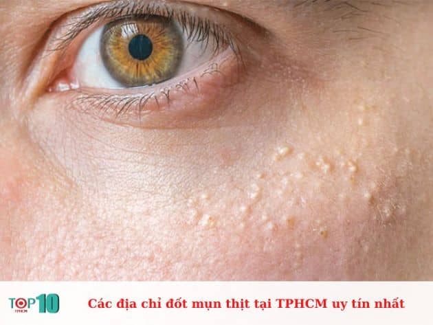 Các địa chỉ đốt mụn thịt tại TPHCM uy tín nhất