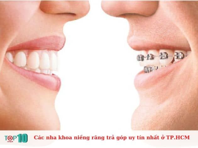 Những nha khoa uy tín tại TP.HCM cung cấp dịch vụ niềng răng trả góp