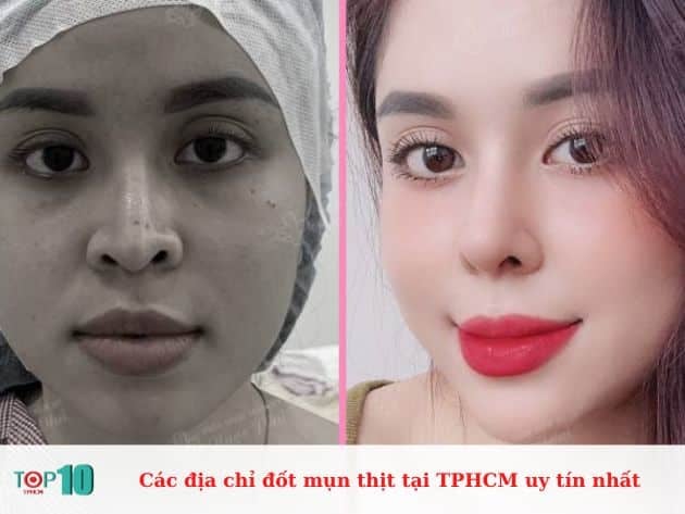 Danh sách các cơ sở đốt mụn thịt uy tín tại TPHCM